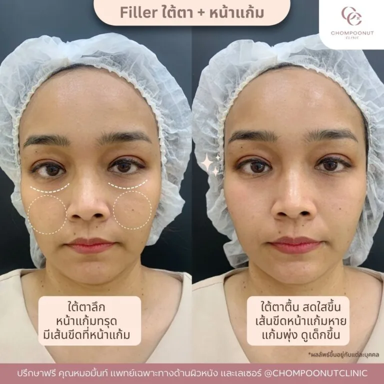 Review Filler ใต้ตา หน้าแก้ม - ชมพูนุทคลินิก คลินิกความงาม นครปฐม