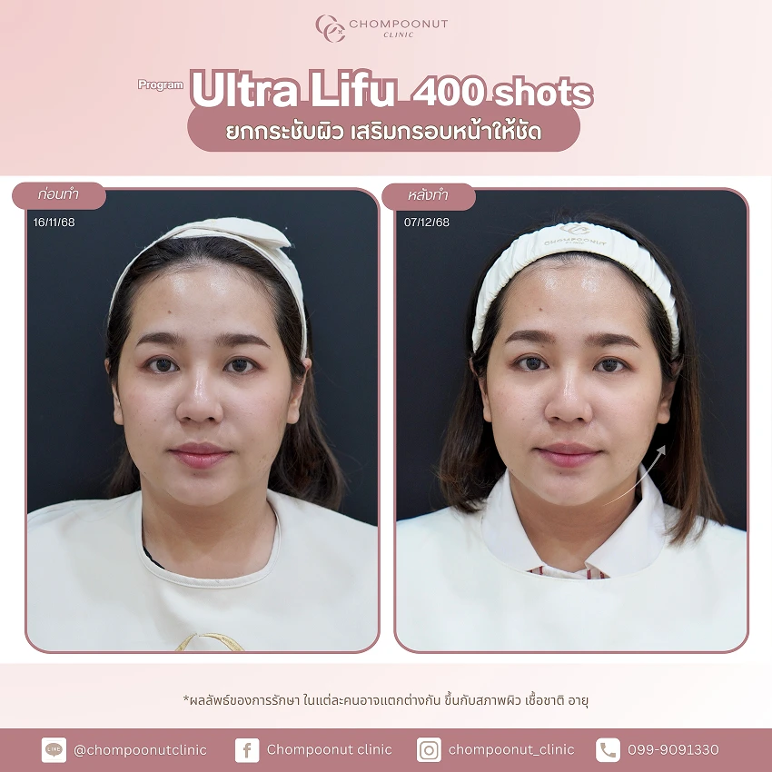 รีวิว Ultra LIFU ชมพูนุชคลินิค นครปฐม