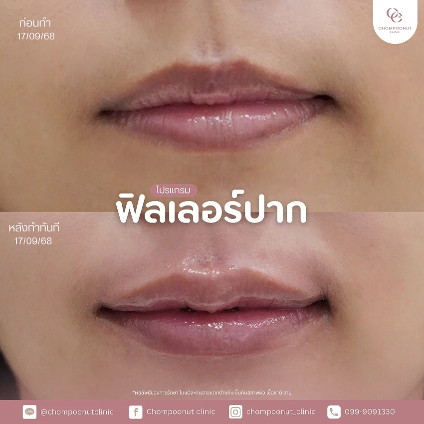 รีวิวฉีดฟีลเลอร์ปาก ชมพูนุชคลินิค นครปฐม ฉีดปาก