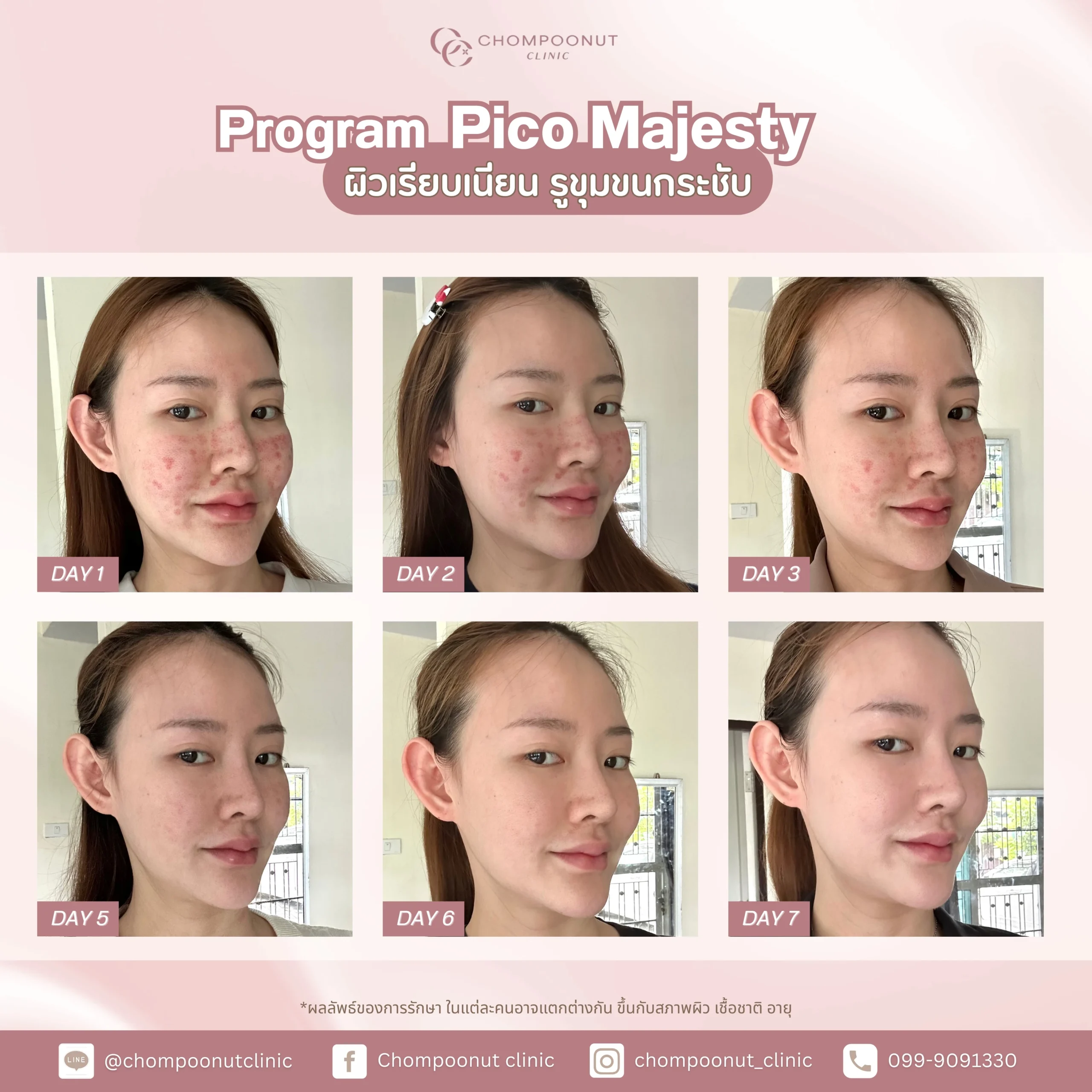 รีวิว Pico ฝ้า กระ ชมพูนุชคลินิค นครปฐมรีวิว Sculptra ชมพูนุชคลินิค นครปฐม