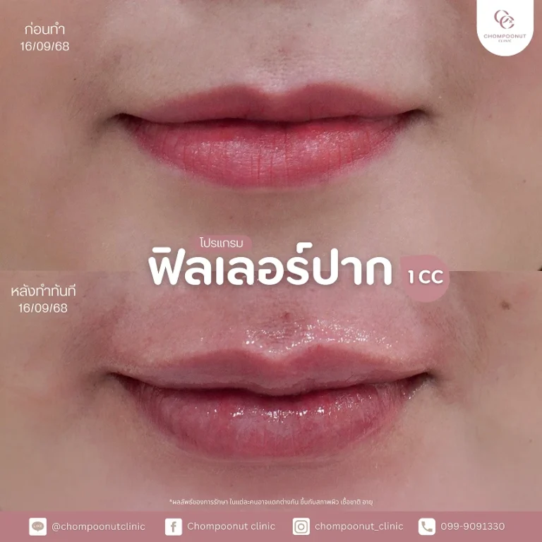 รีวิวฉีดฟีลเลอร์ปาก ชมพูนุชคลินิค นครปฐม ฉีดปาก
