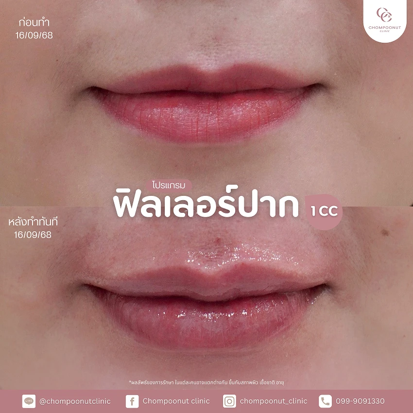 รีวิวฉีดฟีลเลอร์ปาก ชมพูนุชคลินิค นครปฐม ฉีดปาก