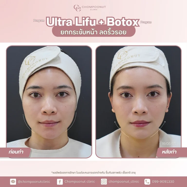 เคสตัวอย่างรับบริการ รีวิว Ultra LIFU + Botox ดูแลผิวหน้าใส คลินิกหมอชมพูนุท