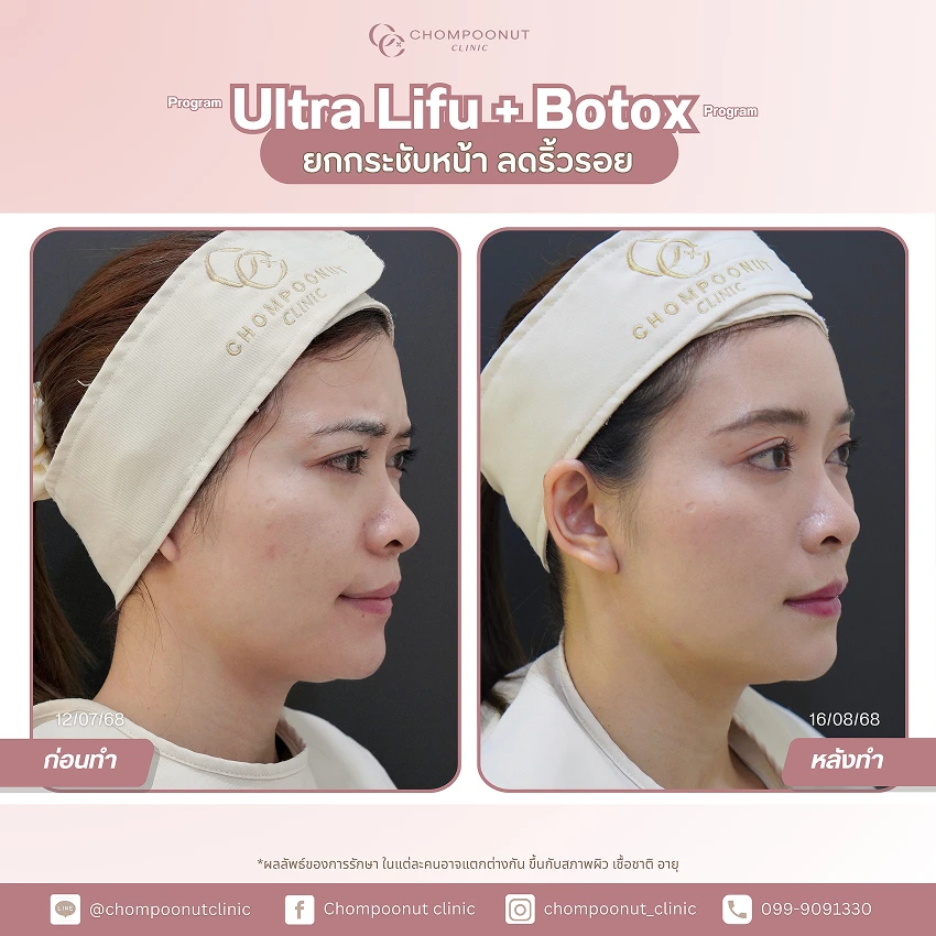รีวิว Ultra LIFU+ Botox ชมพูนุชคลินิค นครปฐม