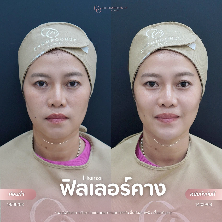 รีวิวฉีดฟีลเลอร์คาง ชมพูนุชคลินิค นครปฐม