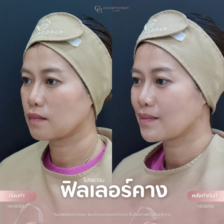 รีวิวฉีดฟีลเลอร์คาง ชมพูนุชคลินิค นครปฐม