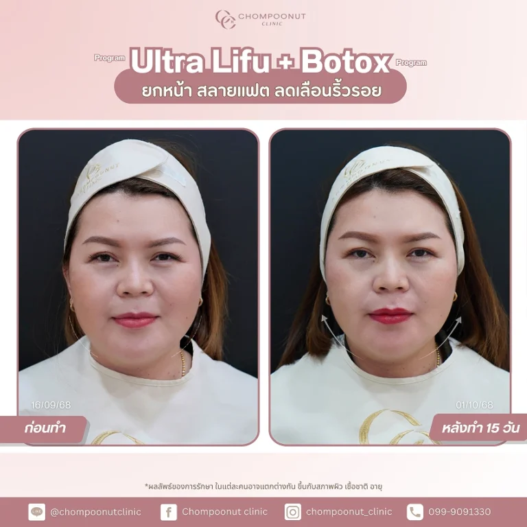 ความประทับใจหลังทำโปรแกรม รีวิว Ultra LIFU + Botox กระชับกรอบหน้า