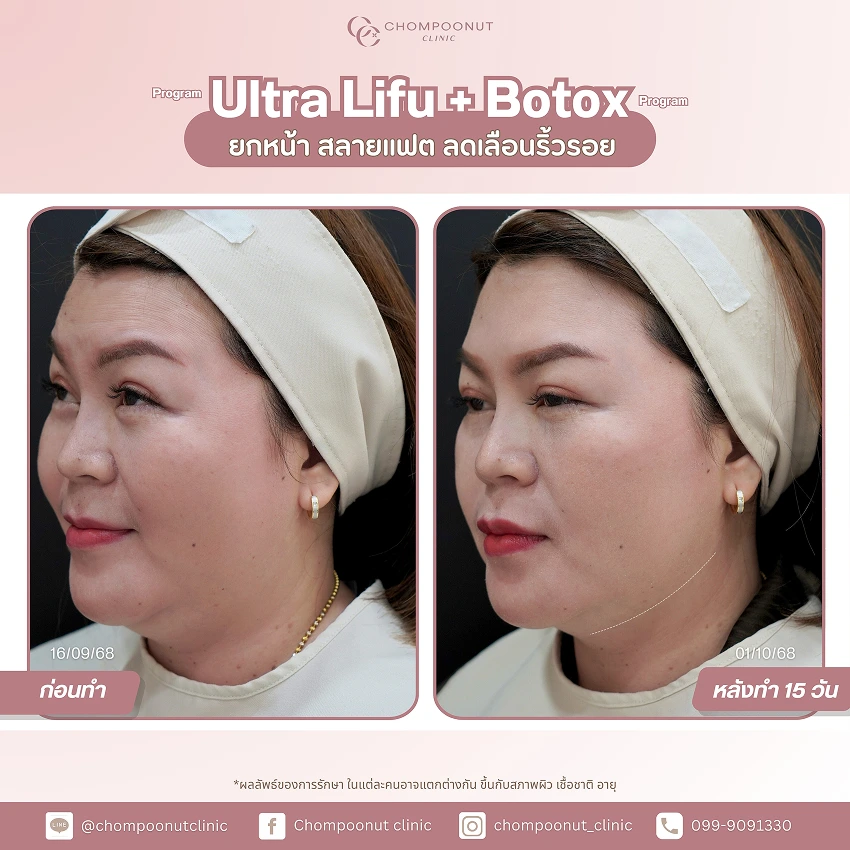 รีวิว Ultra LIFU+ Botox ชมพูนุชคลินิค นครปฐม