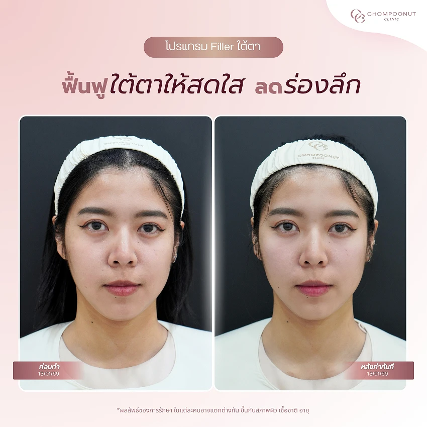 รีวิวฉีดฟีลเลอร์ใต้ตา ชมพูนุชคลินิค นครปฐม