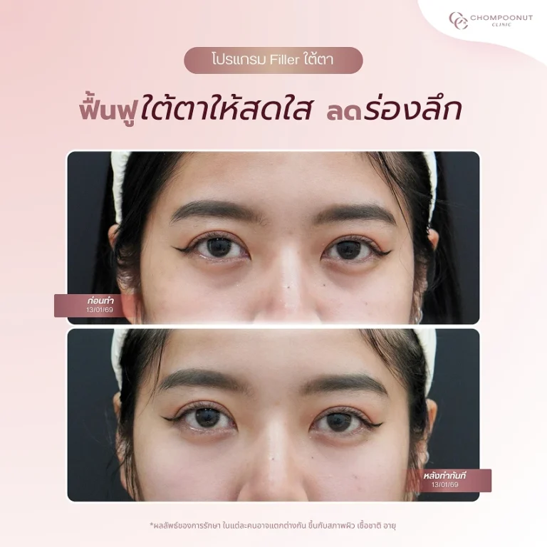 ฟิลเลอร์ใต้ตา นครปฐม