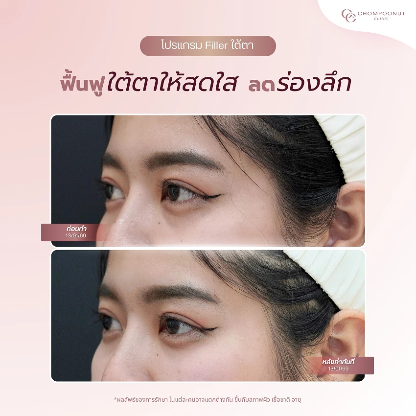 รีวิวฉีดฟีลเลอร์ใต้ตา ชมพูนุชคลินิค นครปฐม