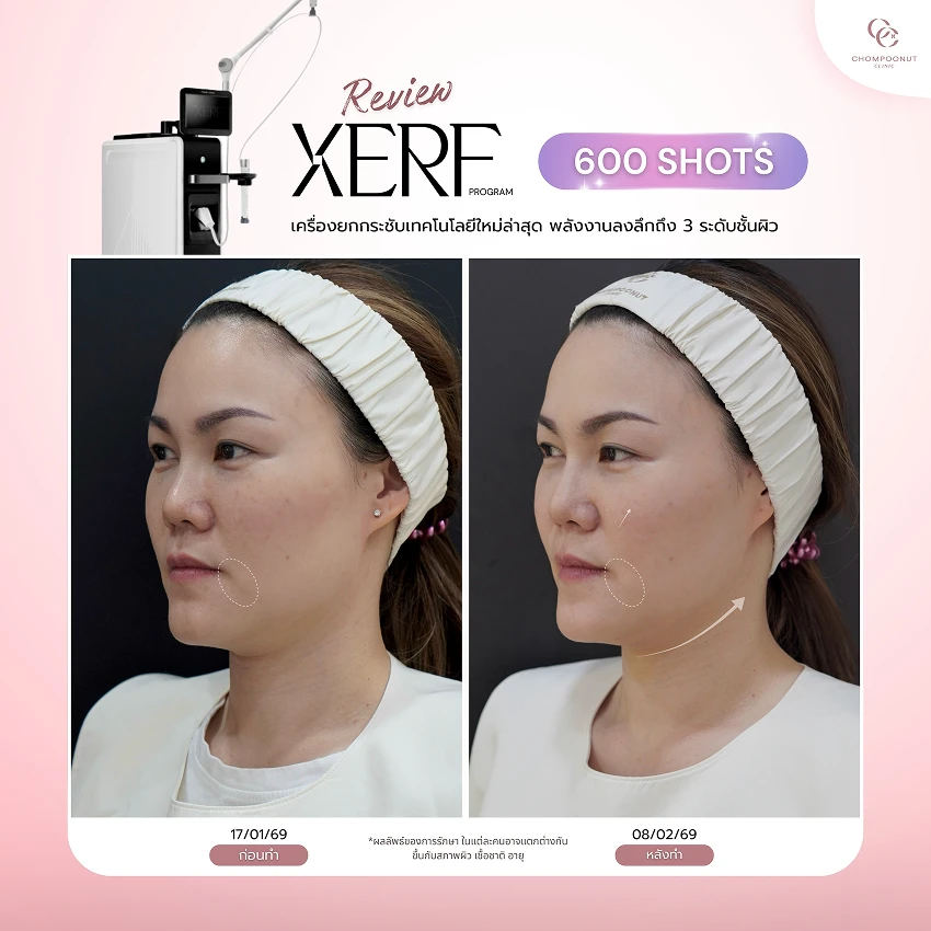 รีวิว XERF ชมพูนุชคลินิค นครปฐมรีวิว Sculptra ชมพูนุชคลินิค นครปฐม