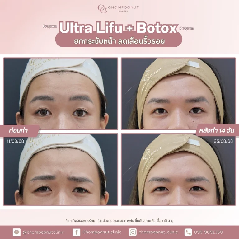 รีวิวฉีด โบท็อกซ์ ฟิลเลอร์ ชมพูนุชคลินิค นครปฐม Botox