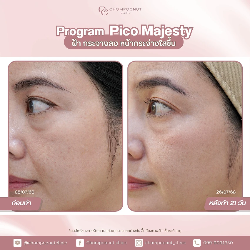 รีวิว Pico Majesty ฝ้า กระ ชมพูนุชคลินิค นครปฐมรีวิว Sculptra ชมพูนุชคลินิค นครปฐม