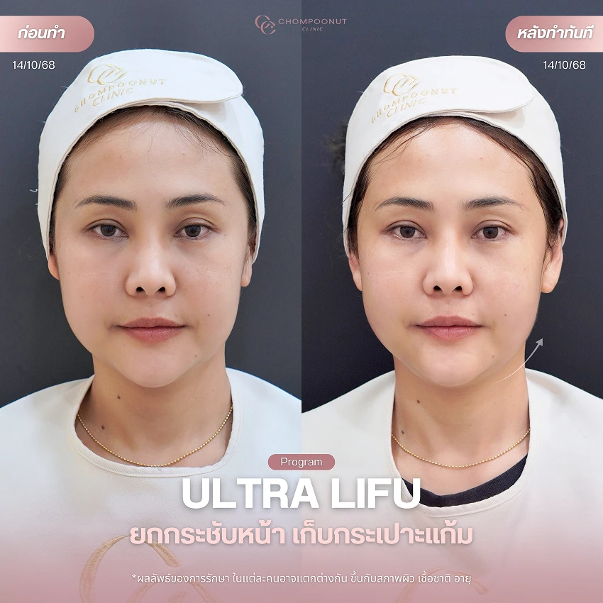 รีวิว Ultra LIFU ชมพูนุชคลินิค นครปฐม