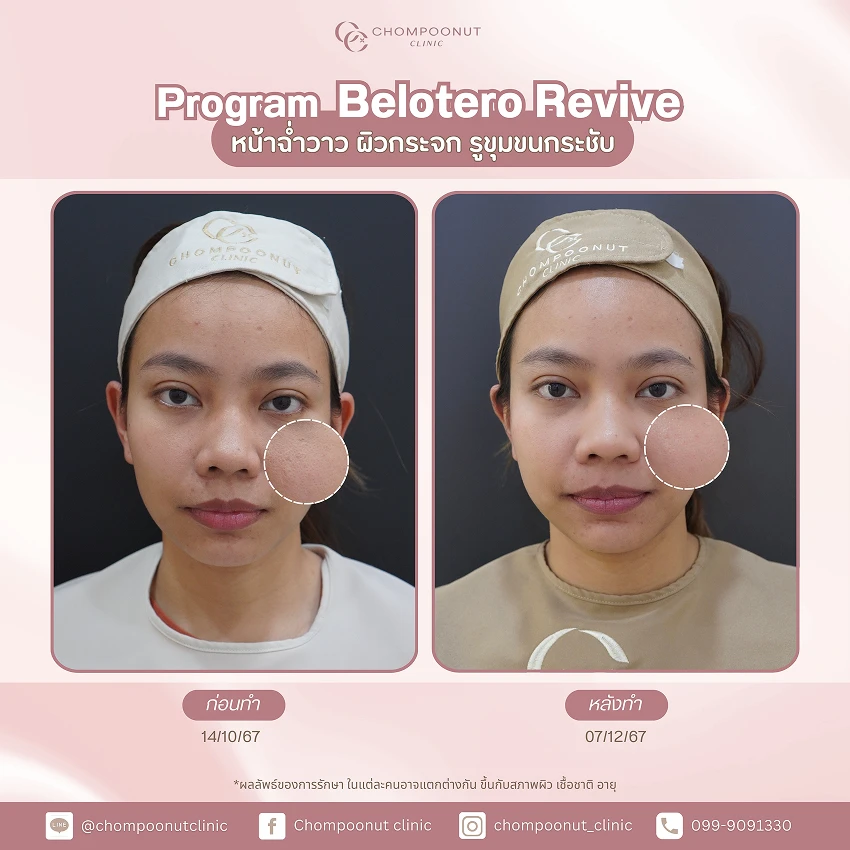 รีวิว Belotero Revive ชมพูนุชคลินิค นครปฐม
