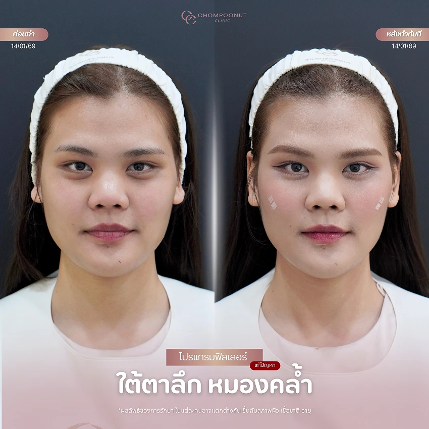 รีวิวฉีดฟีลเลอร์คาง ชมพูนุชคลินิค นครปฐม