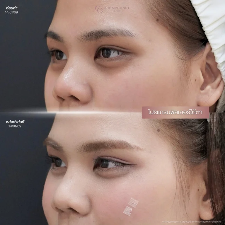รีวิวฉีดฟีลเลอร์ใต้ตา ชมพูนุชคลินิค นครปฐม