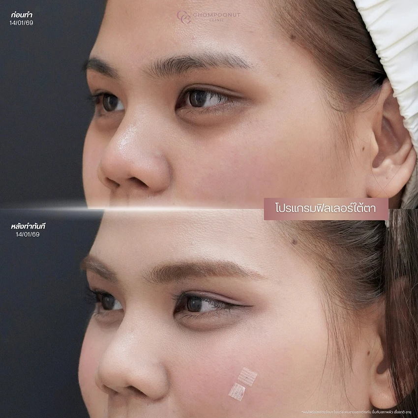 รีวิวฉีดฟีลเลอร์ใต้ตา ชมพูนุชคลินิค นครปฐม