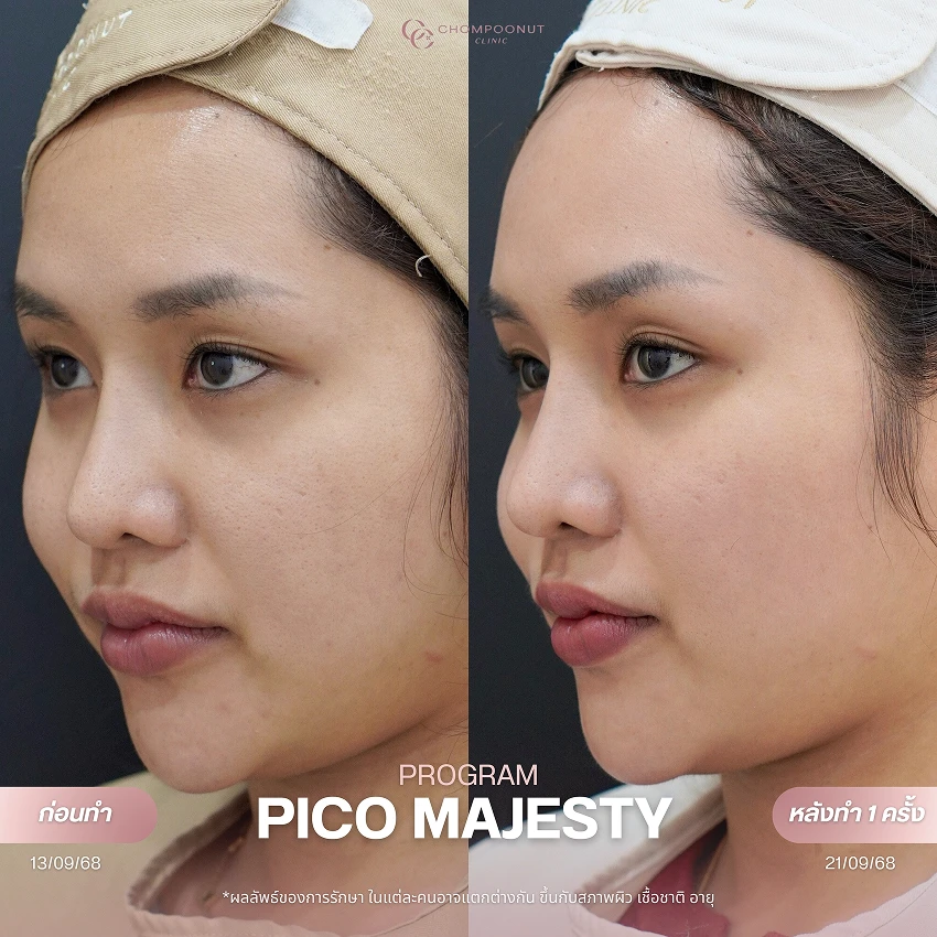 รีวิว Pico Majesty ฝ้า กระ ชมพูนุชคลินิค นครปฐมรีวิว Sculptra ชมพูนุชคลินิค นครปฐม
