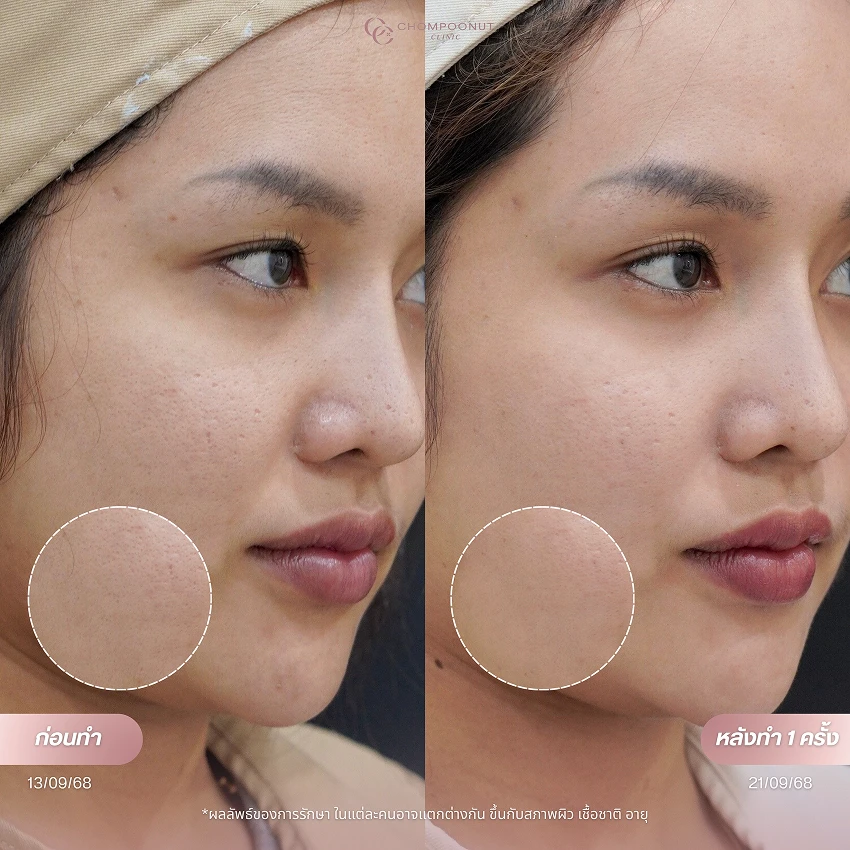 รีวิว Pico Majesty ฝ้า กระ ชมพูนุชคลินิค นครปฐมรีวิว Sculptra ชมพูนุชคลินิค นครปฐม