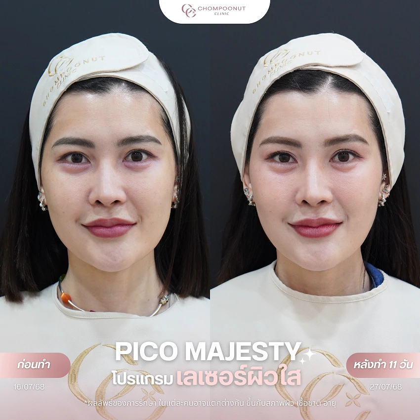 รีวิว Pico Majesty ฝ้า กระ ชมพูนุชคลินิค นครปฐมรีวิว Sculptra ชมพูนุชคลินิค นครปฐม