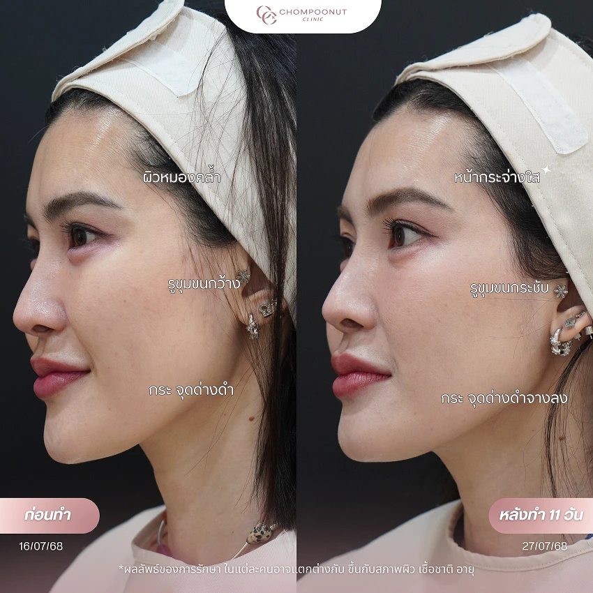 รีวิว Pico Majesty ฝ้า กระ ชมพูนุชคลินิค นครปฐมรีวิว Sculptra ชมพูนุชคลินิค นครปฐม