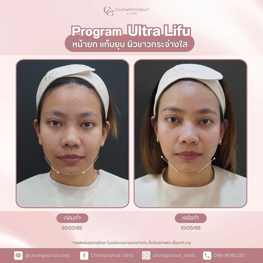 รีวิว Ultra LIFU ชมพูนุชคลินิค นครปฐม