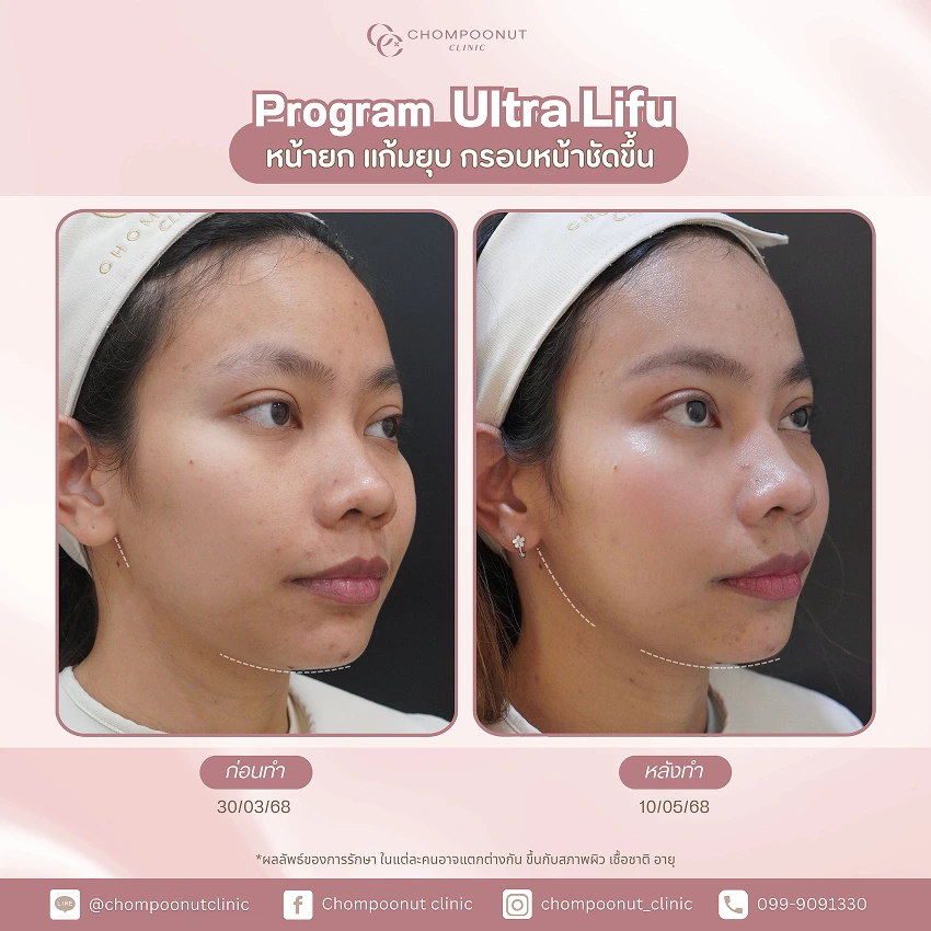 รีวิว Ultra LIFU ชมพูนุชคลินิค นครปฐม