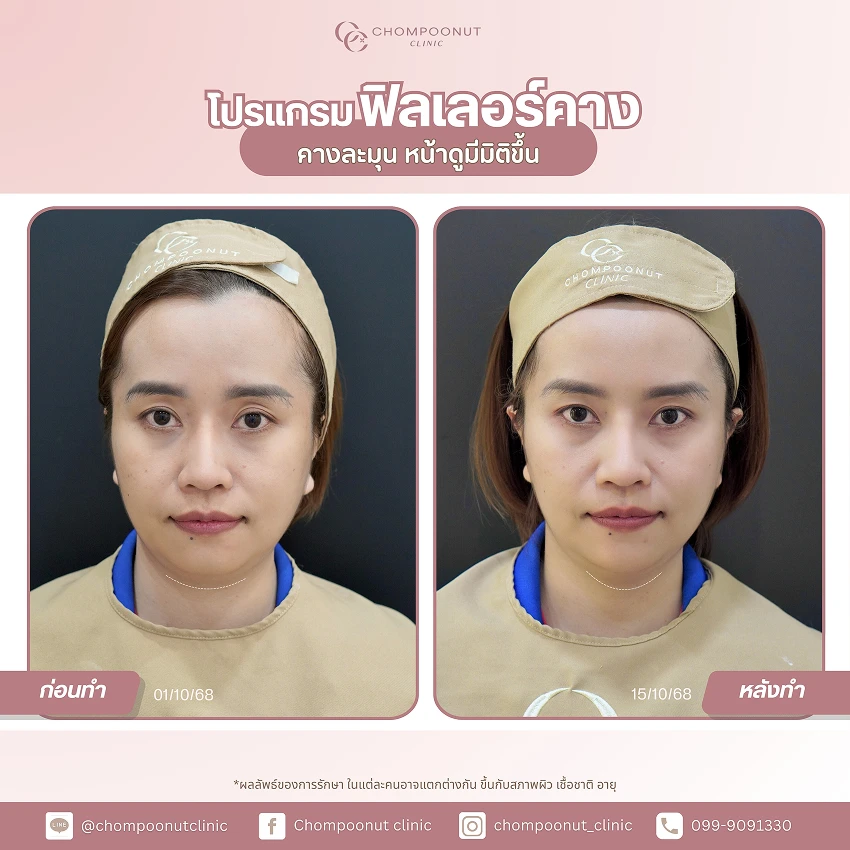 รีวิวฉีดฟีลเลอร์คาง ชมพูนุชคลินิค นครปฐม