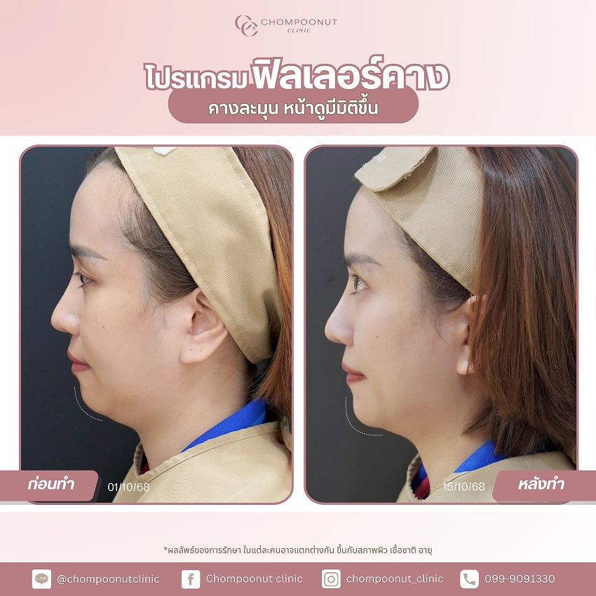 รีวิวฉีดฟีลเลอร์คาง ชมพูนุชคลินิค นครปฐม