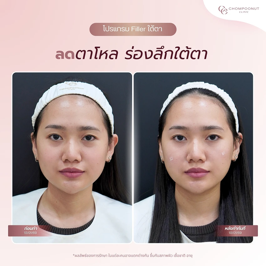 รีวิวฉีดฟีลเลอร์ใต้ตา ชมพูนุชคลินิค นครปฐม