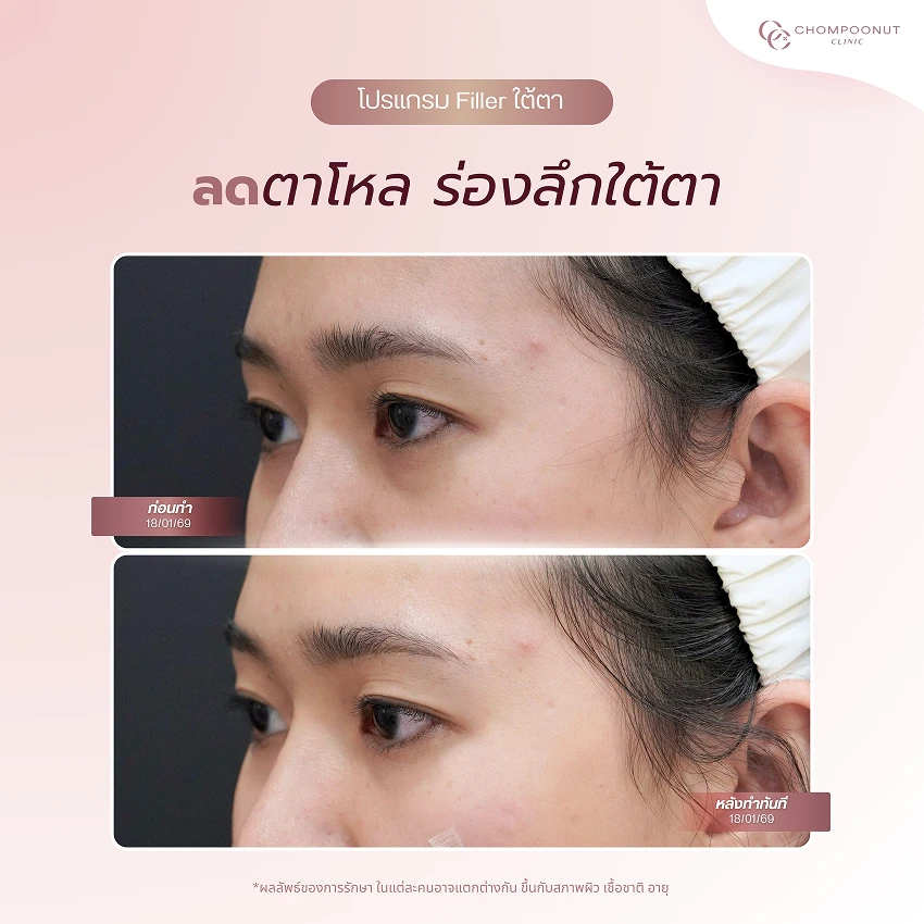 รีวิวฉีดฟีลเลอร์ใต้ตา ชมพูนุชคลินิค นครปฐม