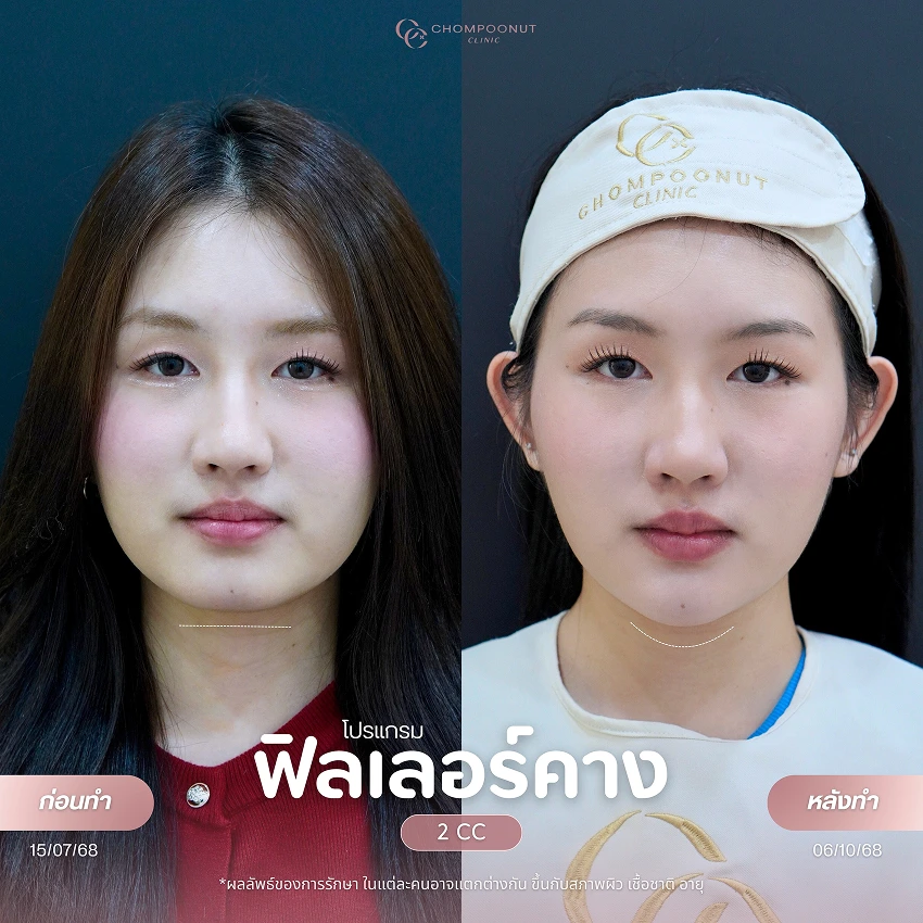 รีวิวฉีดฟีลเลอร์คาง ชมพูนุชคลินิค นครปฐม