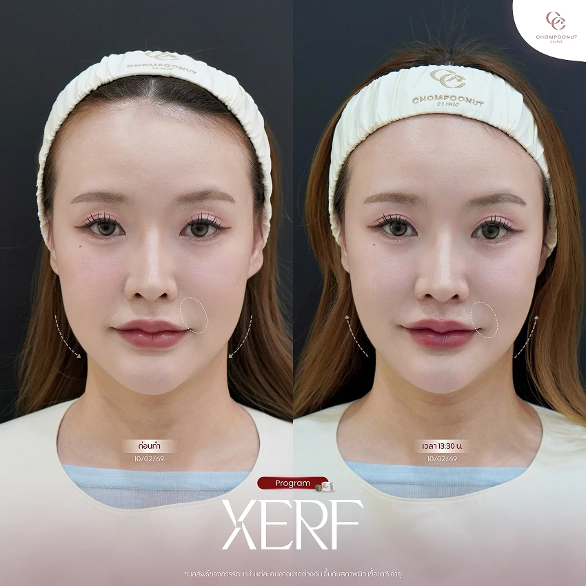รีวิว XERF ชมพูนุชคลินิค นครปฐมรีวิว Sculptra ชมพูนุชคลินิค นครปฐม