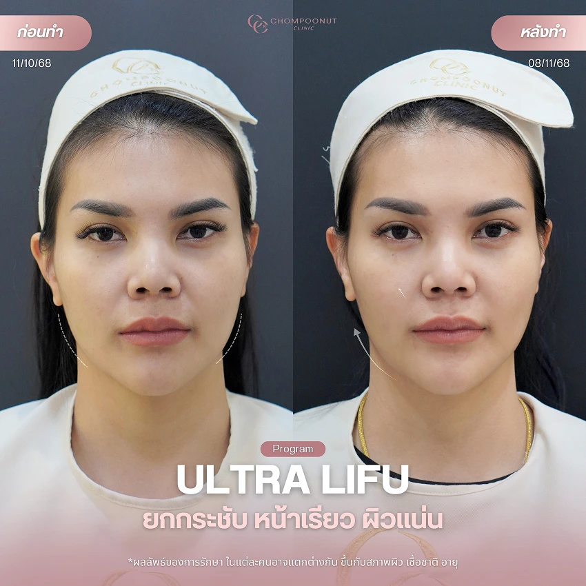 รีวิว Ultra LIFU ชมพูนุชคลินิค นครปฐม