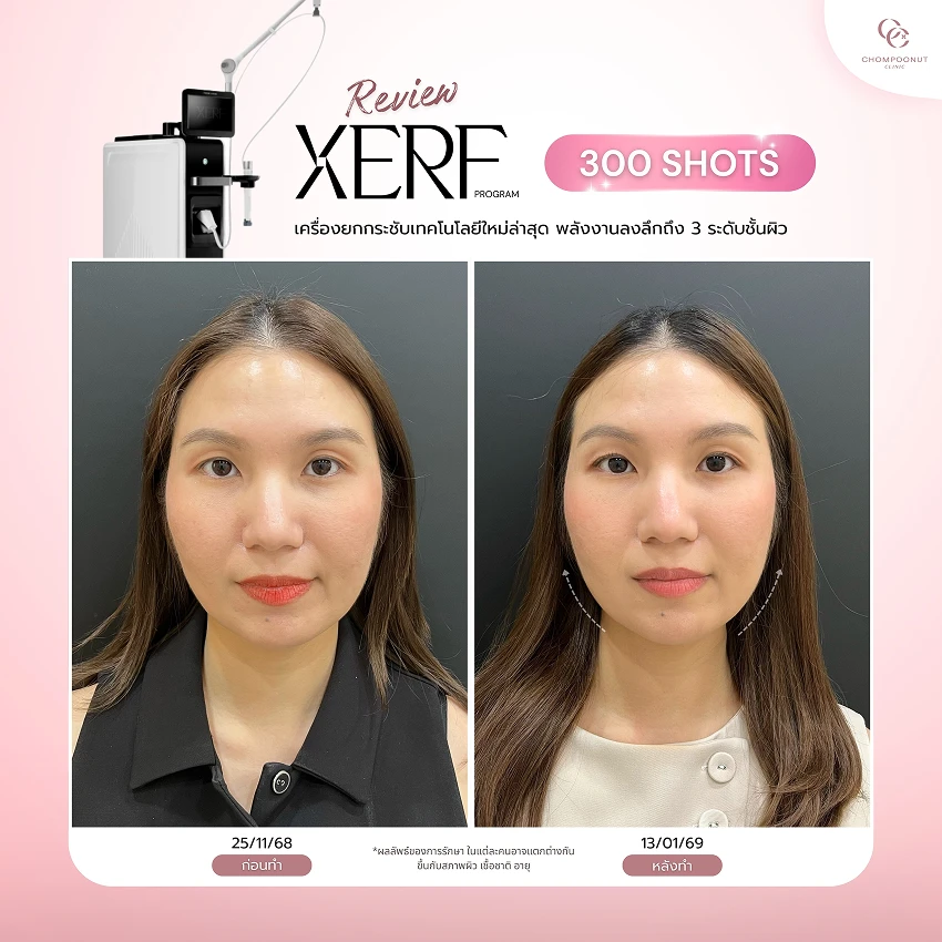 รีวิว XERF ชมพูนุชคลินิค นครปฐมรีวิว Sculptra ชมพูนุชคลินิค นครปฐม