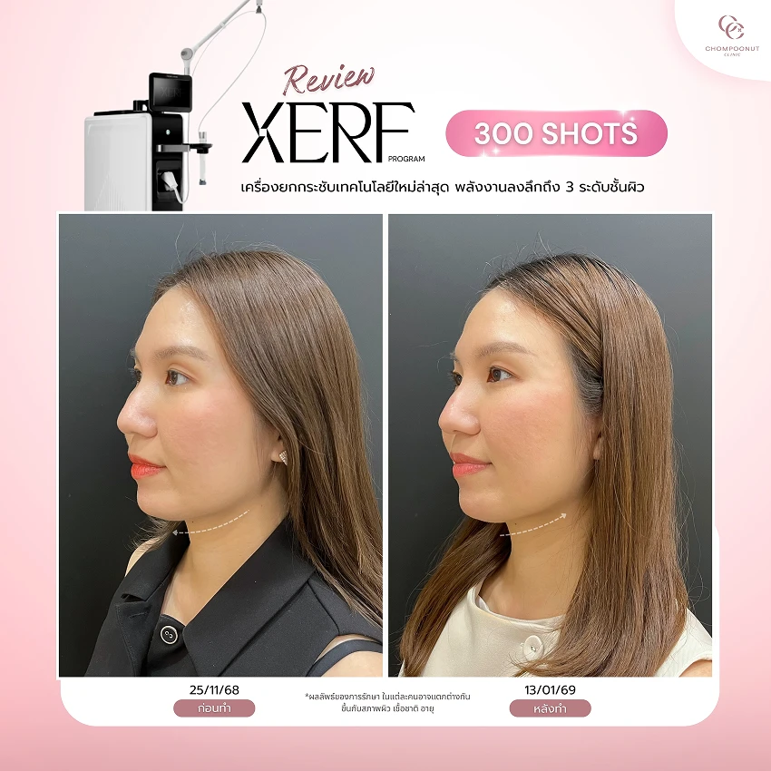 รีวิว XERF ชมพูนุชคลินิค นครปฐมรีวิว Sculptra ชมพูนุชคลินิค นครปฐม