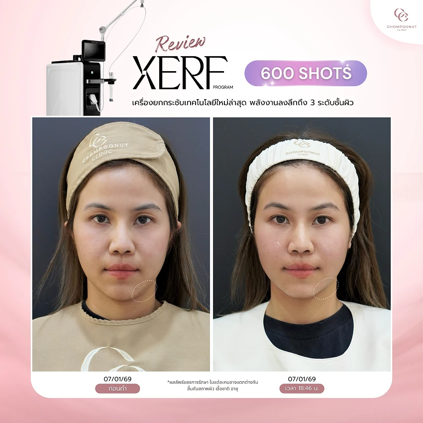 รีวิว XERF ชมพูนุชคลินิค นครปฐมรีวิว Sculptra ชมพูนุชคลินิค นครปฐม