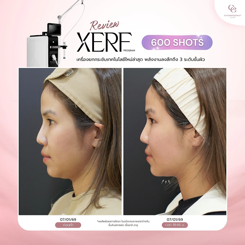 รีวิว XERF ชมพูนุชคลินิค นครปฐมรีวิว Sculptra ชมพูนุชคลินิค นครปฐม