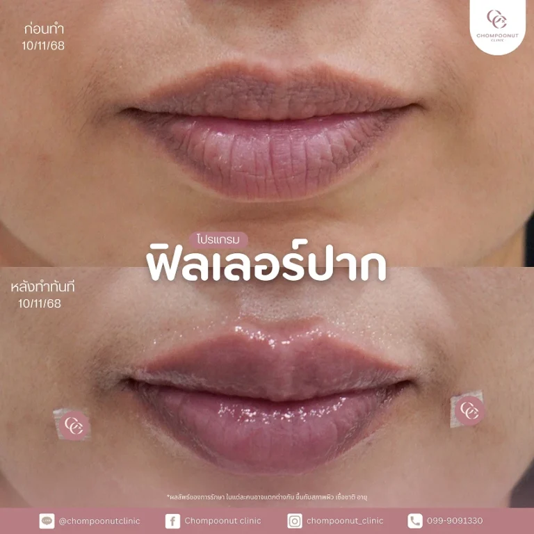 รีวิวฉีดฟีลเลอร์ปาก ชมพูนุชคลินิค นครปฐม ฉีดปาก