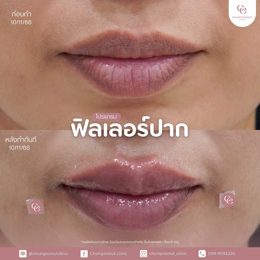 รีวิวฉีดฟีลเลอร์ปาก ชมพูนุชคลินิค นครปฐม ฉีดปาก