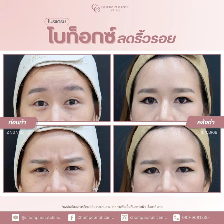 รีวิวฉีด โบท็อกซ์ลดริ้วรอย ชมพูนุชคลินิค นครปฐม Botox