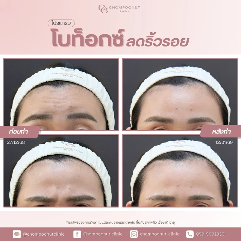 รีวิวฉีด โบท็อกซ์ลดริ้วรอย ชมพูนุชคลินิค นครปฐม Botox