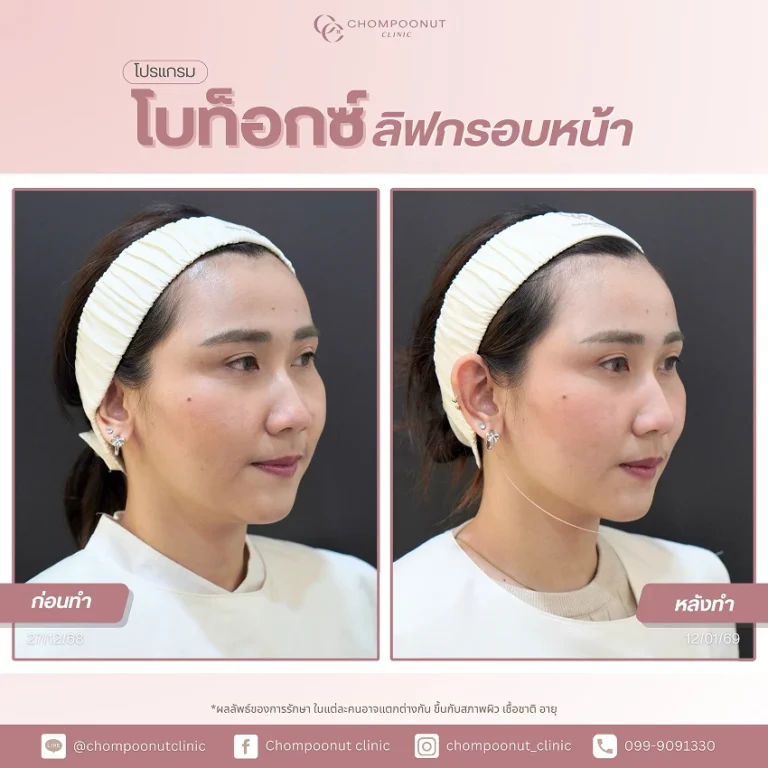 รีวิวฉีด โบท็อกซ์ลิฟท์กรอบหน้า ชมพูนุชคลินิค นครปฐม Botox