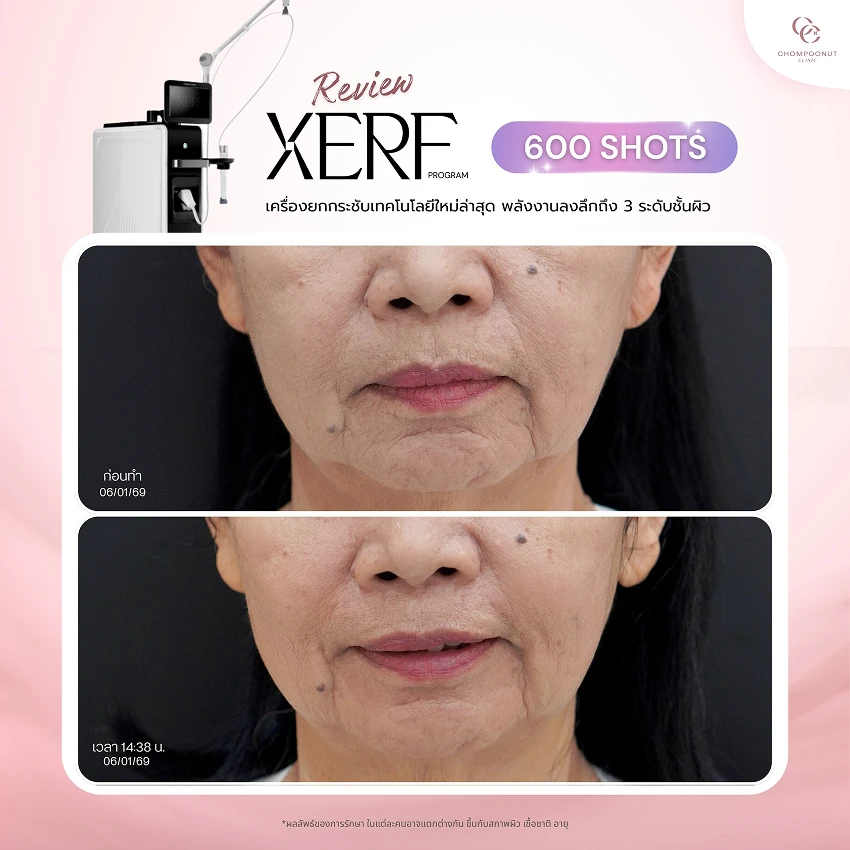 รีวิว XERF ชมพูนุชคลินิค นครปฐมรีวิว Sculptra ชมพูนุชคลินิค นครปฐม