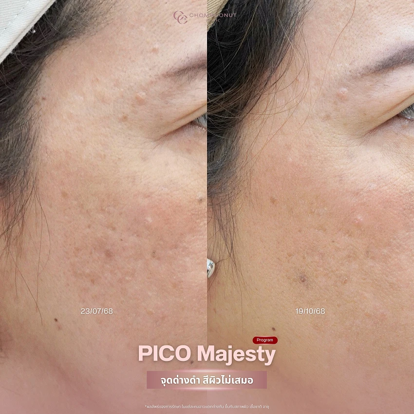 รีวิว Pico Majesty ฝ้า กระ ชมพูนุชคลินิค นครปฐมรีวิว Sculptra ชมพูนุชคลินิค นครปฐม