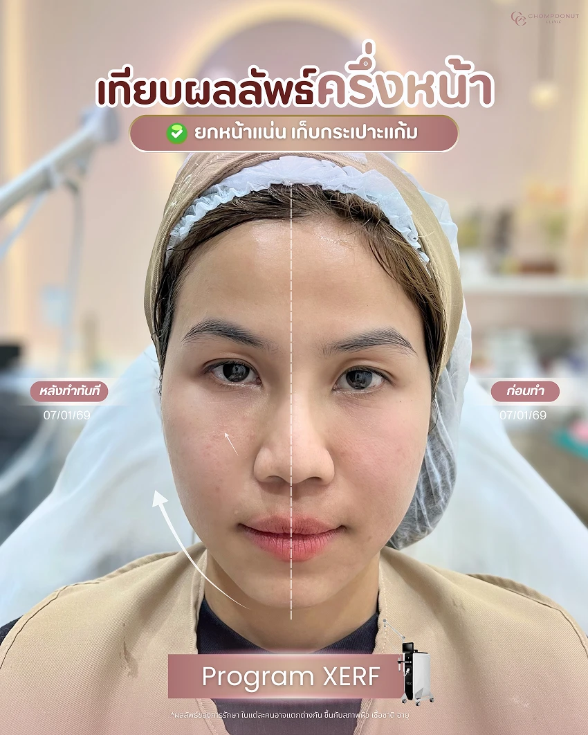 รีวิว XERF ชมพูนุชคลินิค นครปฐมรีวิว Sculptra ชมพูนุชคลินิค นครปฐม