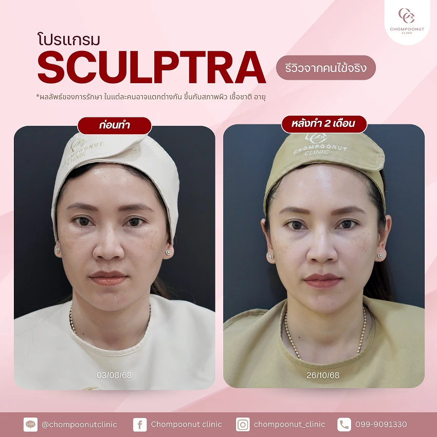 รีวิว Sculptra ชมพูนุชคลินิค นครปฐม