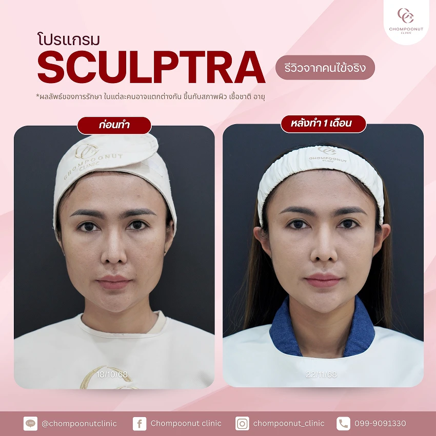 รีวิว Sculptra ชมพูนุชคลินิค นครปฐม